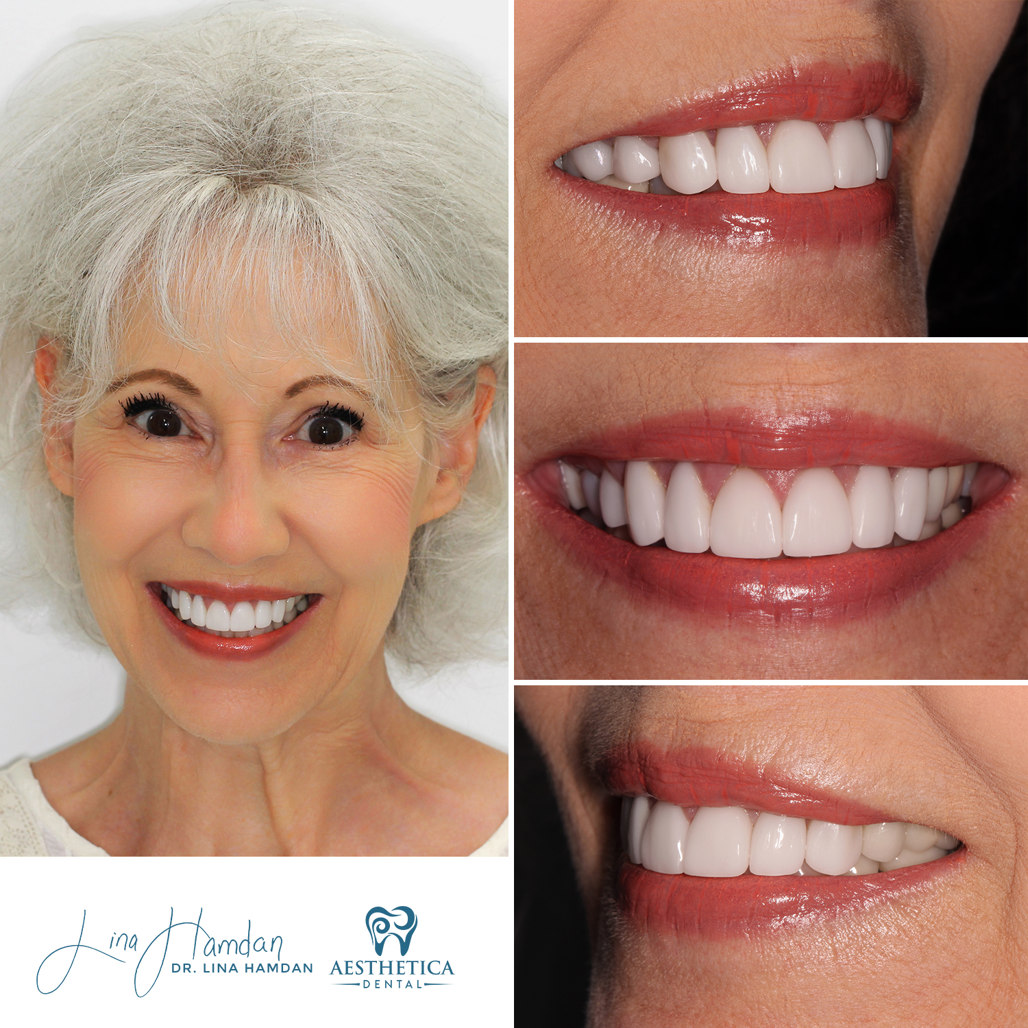 Porcelain Veneers case 2 done by Dr. Lina Hamdan. - Before and After Images - 2